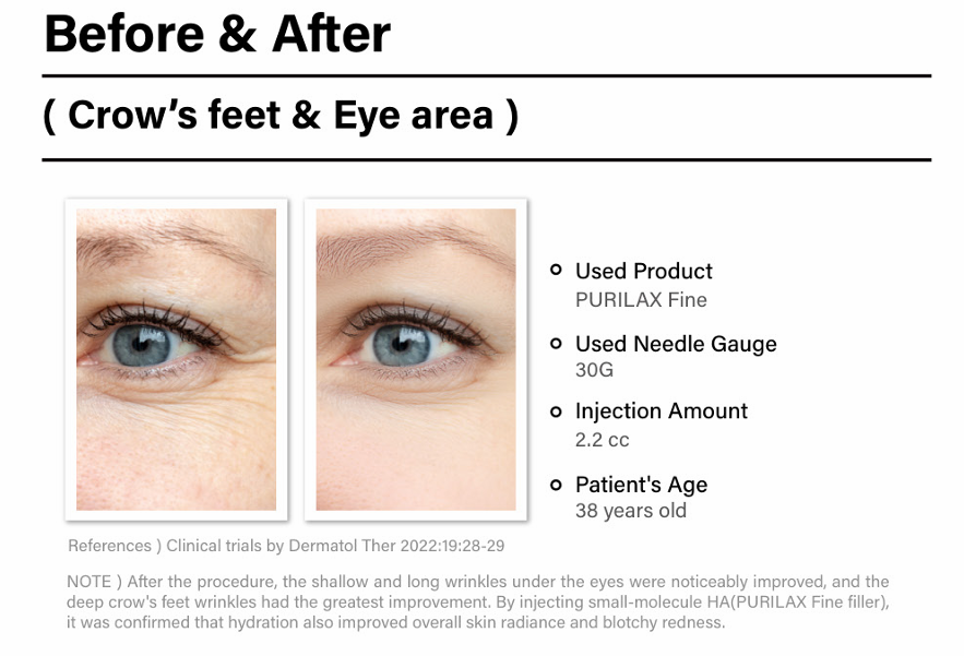 Purilax with Lidocaine